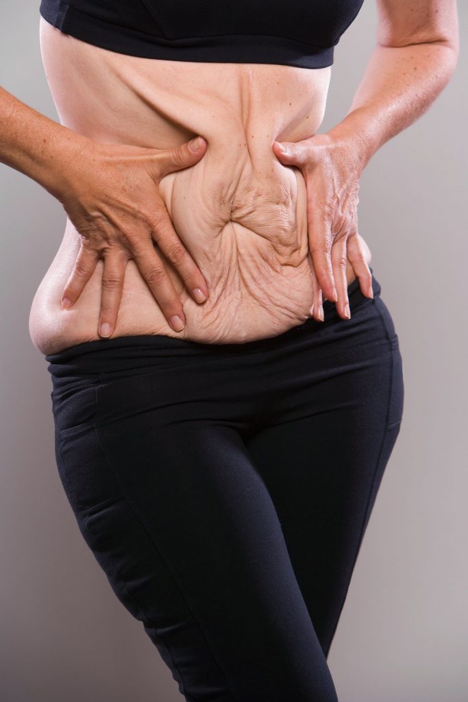 Veel mensen zonder obesitas kopen Ozempic zonder recept, maar weten niet wat er met hun gezicht, borsten en buikwand gaat gebeuren
